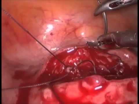 video-linktoworks-Uterine Fibroids Removal