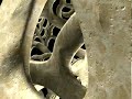 osteoporosis