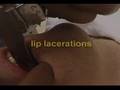 intubation