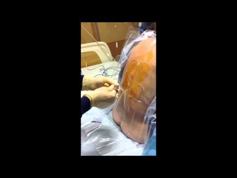 how to remove epidural catheter