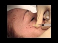 Dr. Araco Antonino - Tossina Botulinica