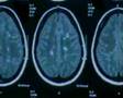 Optimizing Quality of Life in MS Patients. Neuroprotection.