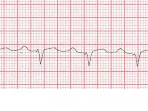 how to measure the p-r interval