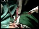 appendectomy surgery JOMAR MARCELO double ligation  appendix