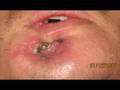 Cirugia Maxilofacial Osteosintesis