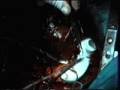 Clinical Case Aorta Substitution by Expandable Prosthesis