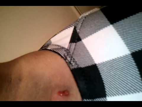 how to drain armpit boil