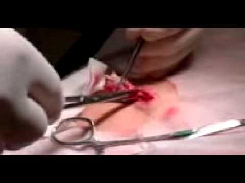 Cirurgia de cisto sebáceo do David
