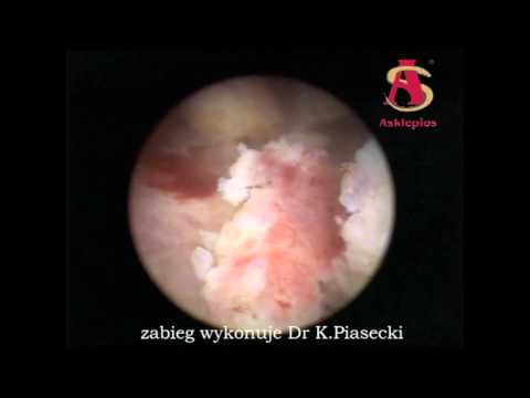 endometrium - Zabieg wykonuje Dr K.Piasecki www.asklepios.pl www.facebook.com/asklepios.rzeszow.