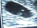videos de EMBARAZO 5.6 SEMANAS - PREGNANCY 5.6 WEEKS, VAGINAL SCAN