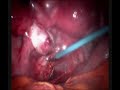 Adhesions and the female organs Adhesions