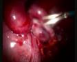 Adhesions and the female organs