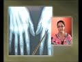 scandale Maroc la CNSS ne prend pas en charge la polyarthrite rhumatoïde.mp4