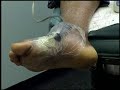 limb salvage media clip