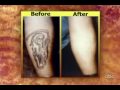 Erasing Tattoos & Spider Veins on The View