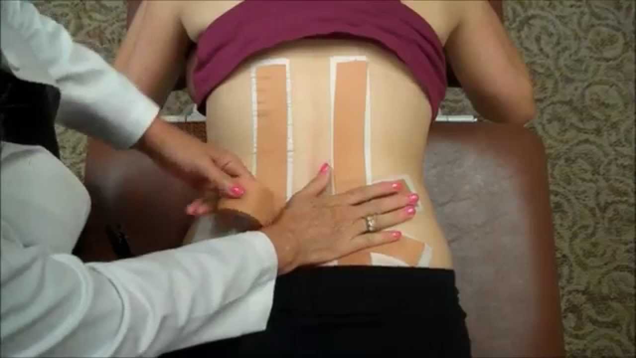 External Fixation of Sacroiliac Joint (SI Joint)