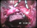 Vesicovaginal Fistula Repair