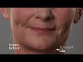 Radiesse at Ageless Remedies Alpharetta