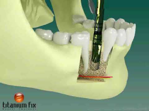 Implante Dental - Seqüência Cirúrgica