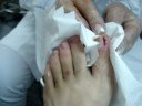 Unha Encravada – Como desencravar, tratamento – video aula demonstrativa