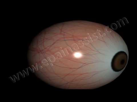 how to relieve ischemic pain