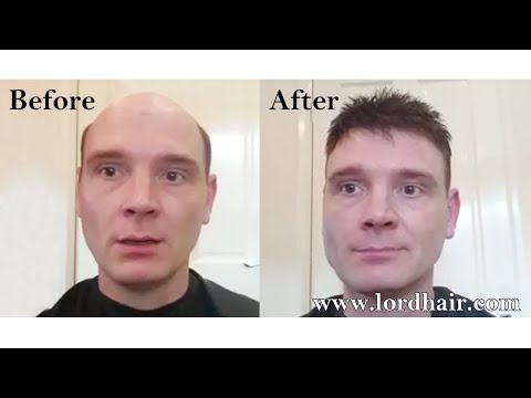 Hair Replacement Before & After