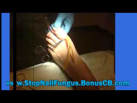 how to cure onychomycosis