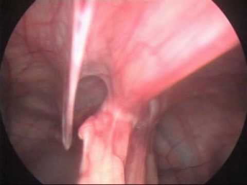 how to remove copper t