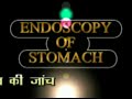 GASTROSCOPY Duodenal Ulcers