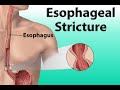 consequences-of-regular-heartburn-health-tip.html