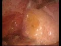 Intervencion de Milles Laparoscopica Colectomy