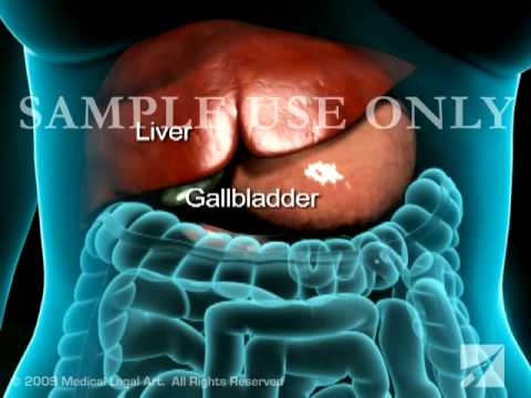 gallbladder removal gallbladder removal scar. gallbladder removal