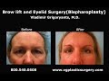 Los angeles eyelid surgery and brow lift by Dr. Grigoryants