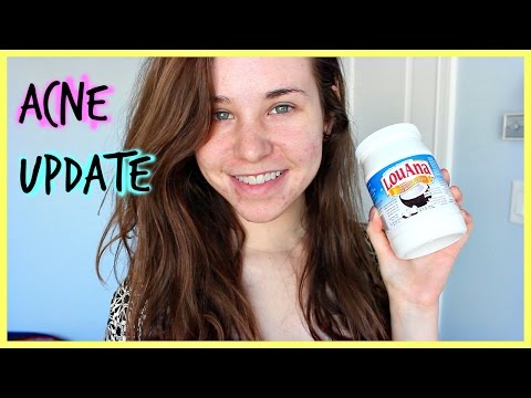 how to use coconut oil for acne