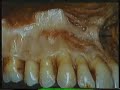 Anesth�sie Intra-orale