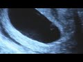 9 Week 3 Day Ultrasound.wmv