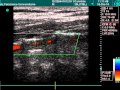 Vertebral Artery In Doppler Examination Vertebral Artery In Doppler Examination