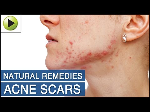 how to treat acne scars naturally