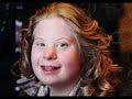 Down syndrome:&nbsp;Down Syndrome Day 2010