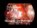 Endoscopic Pituitary Surgery