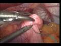 Lap-band_gastrogastric suture#1