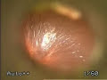 Insertion of ventilation tube for ear infections
