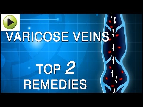 how to avoid varicose veins