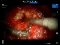 Click here to watch this video Robotic Axillary Dissection