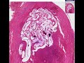 histopathology-soft-tissuefilariasis.html