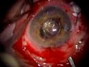 Live Webcast: Innovations in Vitreoretinal Diseases  Glaucoma Eye Diseases