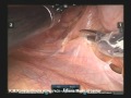 Robotic Adhesiolysis   K M Konstantinidis,MD,PhD,FACS