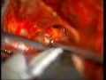 My Brain Surgery - Part 06 of 14