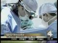 Spinal Cord stimulation