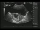 Ecografía 9 semanas - 27 de marzo de 2008 Ecografía 9 semanas - 27 de marzo de 2008